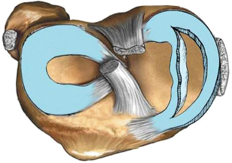 Глава какие бывают разрывы менисков коленного сустава  2